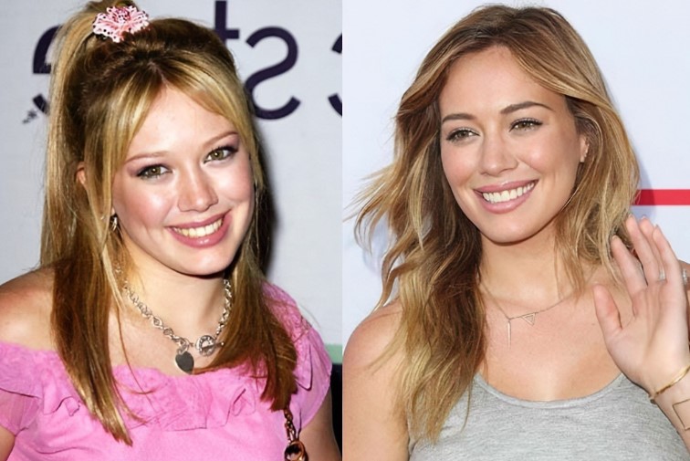 Hilary Duff Plastic Surgery: Everything You Need To Know About Her